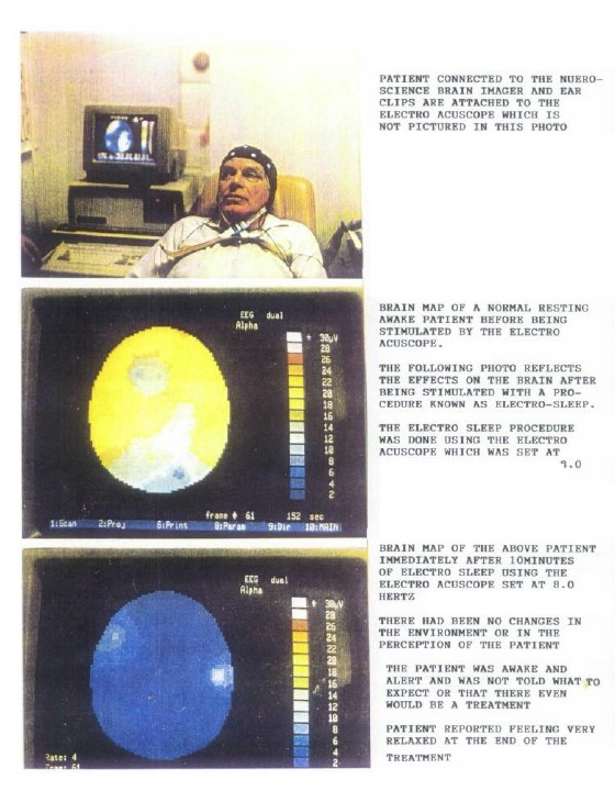 Cranial Electrotherapy Stimulation